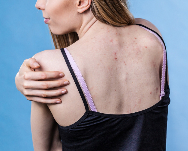 Điều Trị Mụn Lưng Tại Sen Beauty